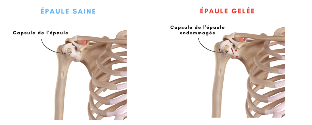 blog capsulite retractile La capsulite rétractile 3